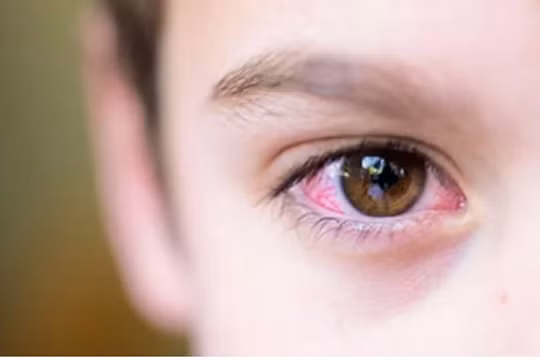 Dịch đau mắt đỏ đang bùng phát 