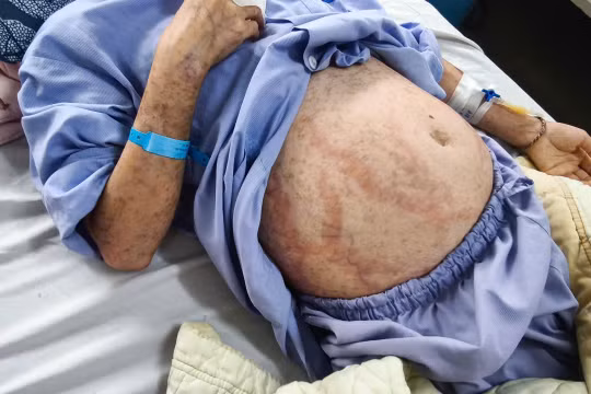 Tự mua thuốc uống, cô gái bị hoại tử da, nhiễm trùng toàn thân