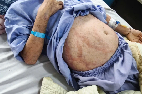 Tự mua thuốc uống, cô gái bị hoại tử da, nhiễm trùng toàn thân