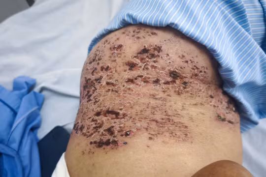 Zona thần kinh ở người cao tuổi dễ bị biến chứng nặng 