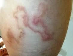 Nuôi 8 con chó mèo, nữ chủ nhân nhập viện vì nhiễm giun đũa