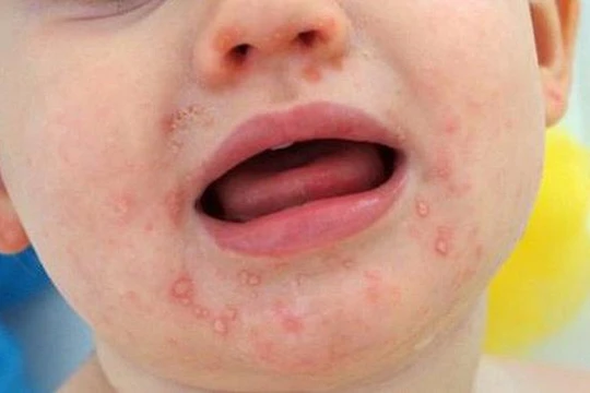 Dịch tay chân miệng tăng mạnh ở Hà Nội và nhiều nơi khác, phòng bệnh thế nào?