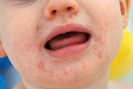 Dịch tay chân miệng tăng mạnh ở Hà Nội và nhiều nơi khác, phòng bệnh thế nào?