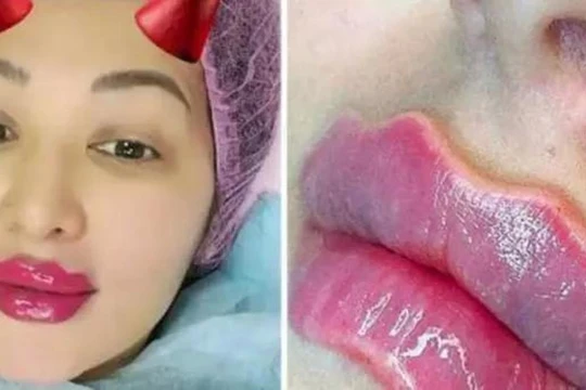 Đẹp thì mỗi người có quan niệm khác nhau nhưng nguy cơ mà “Devil's Lips” gây ra cho sức khỏe là có thật.