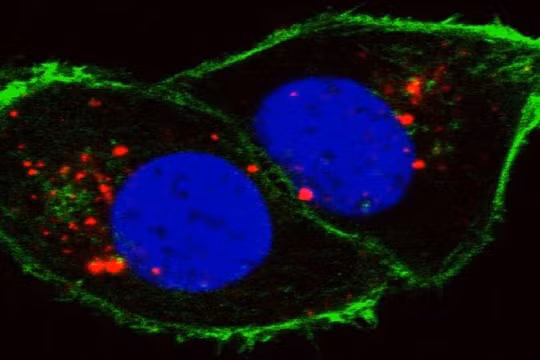 Tế bào ung thư thận (Ảnh Viện nghiên cứu ung thư quốc gia/Đại học Stanford)
