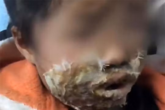 Note 4 phát nổ làm bé gái bị bỏng trên khuôn mặt