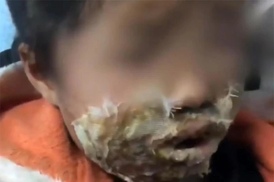 Note 4 phát nổ làm bé gái bị bỏng trên khuôn mặt