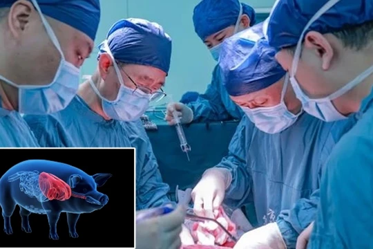 Nhóm khoa học Đại học Y khoa An Huy đã thực hiện thành công ca ghép gan lợn đã chỉnh sửa gene cho bệnh nhân ung thư (Ảnh: Guangming)