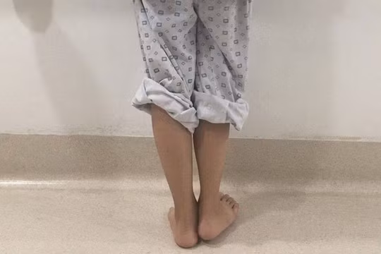 Sau lần phẫu thuật cách đây 4 năm, nữ sinh Đỗ Thị Kim C. phải chịu đôi chân lệch nhau 2 cm, dáng đi tập tễnh khiến em tự ti.