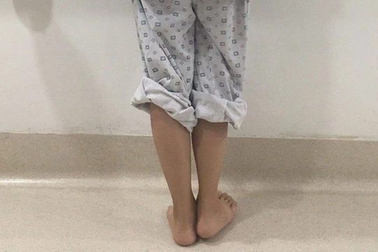 Sau lần phẫu thuật cách đây 4 năm, nữ sinh Đỗ Thị Kim C. phải chịu đôi chân lệch nhau 2 cm, dáng đi tập tễnh khiến em tự ti.
