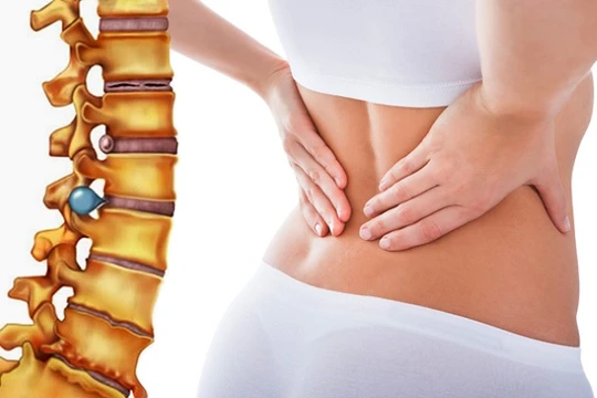 Ảnh minh họa bệnh thoát vị địa đệm cột sống lưng