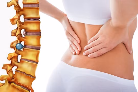 Ảnh minh họa bệnh thoát vị địa đệm cột sống lưng