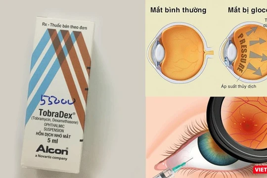Tự ý sử dụng thuốc Tobradex, đôi mắt có thể bị tổn thương nặng, thậm chí mù lòa.