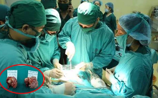 Các bác sĩ phẫu thuật loại bỏ 2 khối u hình giống chiếc xúp lơ có trọng lượng 1,6 kg và 2 kg của các bệnh nhân T. và V.