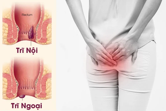Trĩ gây ảnh hưởng tới sinh hoạt hàng ngày của người bệnh.