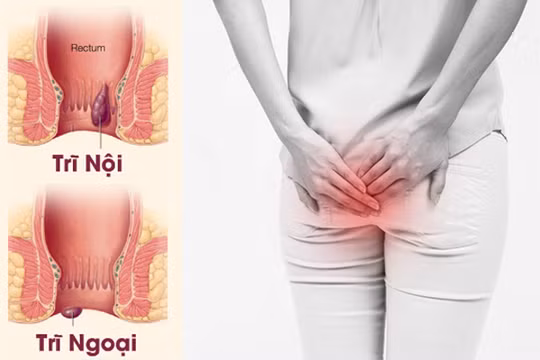 Trĩ gây ảnh hưởng tới sinh hoạt hàng ngày của người bệnh.