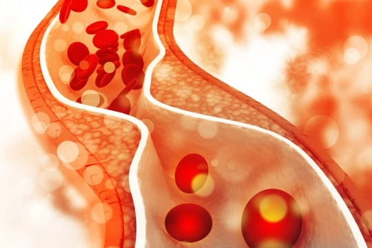 Có quá nhiều cholesterol trong máu ảnh hưởng lớn tới sức khỏe tim mạch.