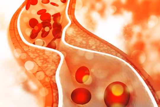 Có quá nhiều cholesterol trong máu ảnh hưởng lớn tới sức khỏe tim mạch.