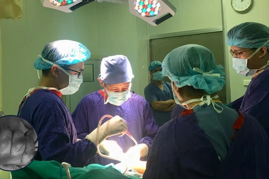 Các bác sĩ của Bệnh viện Hữu nghị Việt Đức vi phẫu bảo tồn bàn tay của bé trai 23 tháng tuổi.