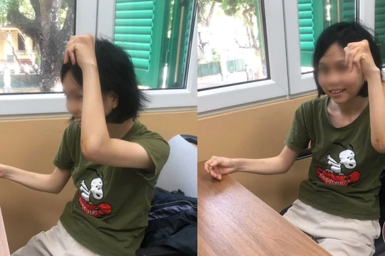 Sau mổ 4 tuần, khớp khuỷu của chị N đã có thể vận động rất tốt.