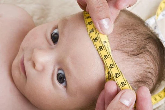 Bệnh nhi mắc não úng thủy (Ảnh minh họa)