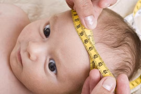 Bệnh nhi mắc não úng thủy (Ảnh minh họa)