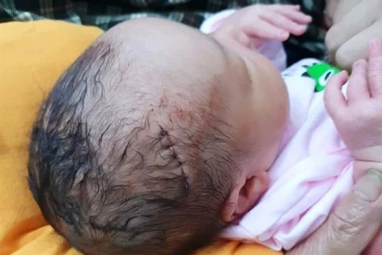 Vừa mới ra đời, em bé này đã phải chịu vết khâu dài 6 mũi.