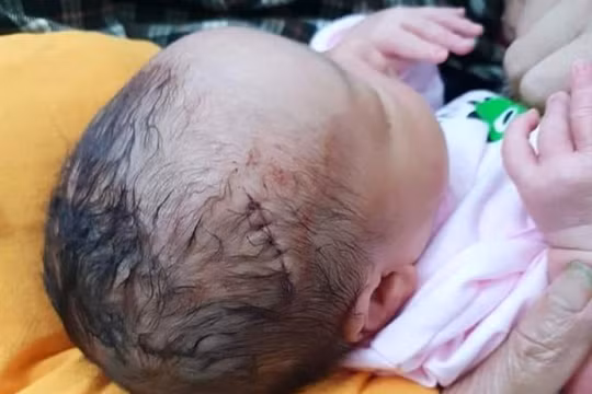 Vừa mới ra đời, em bé này đã phải chịu vết khâu dài 6 mũi.