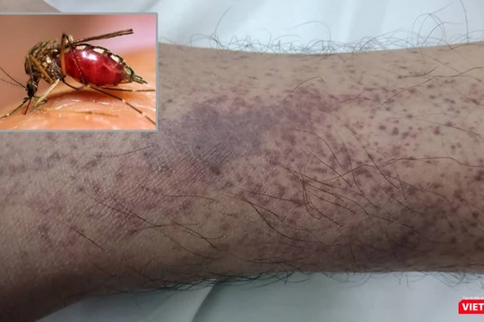 Bệnh nhân bị xuất huyết nặng dưới da do mắc sốt xuất huyết trên nền bệnh tan máu bẩm sinh.