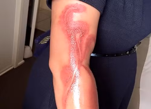 Bỏng tay vì iPhone 7 quá nóng.