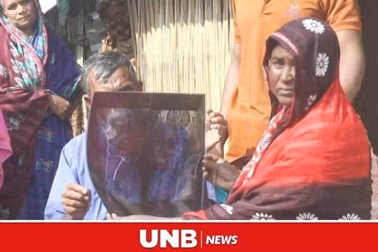 Người phụ nữ phát hiện chiếc kéo nằm trong bụng suốt 20 năm