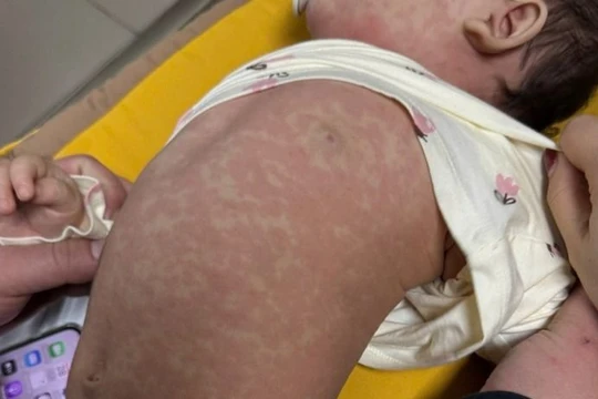 Hơn 1.500 người mắc sởi dịp Tết, dự báo dịch tiếp tục diễn biến phức tạp 