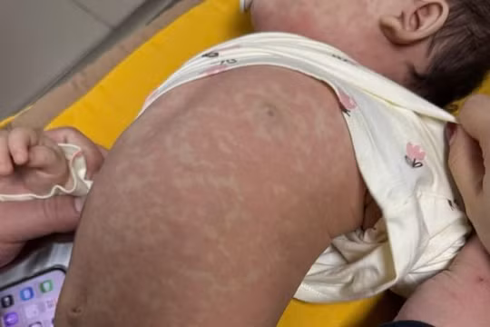 Hơn 1.500 người mắc sởi dịp Tết, dự báo dịch tiếp tục diễn biến phức tạp 