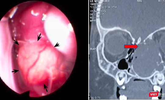 Bé trai 15 tháng tuổi bị lồi mắt, nghẹt mũi vì khối u lớn chèn ép. Ảnh: BVCC