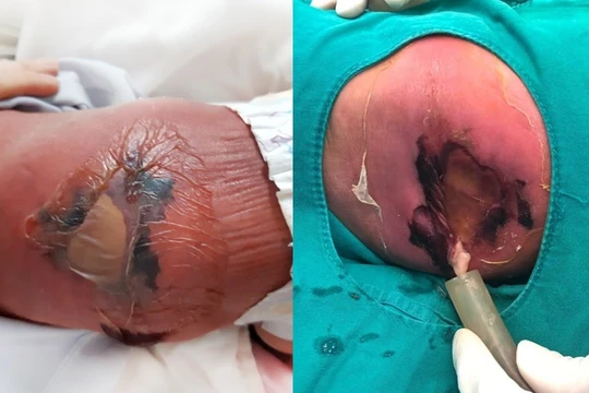 Em bé sơ sinh bị bỏng nặng, hoại tử da vì mẹ cho nằm than