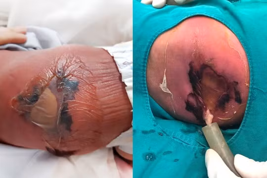 Em bé sơ sinh bị bỏng nặng, hoại tử da vì mẹ cho nằm than