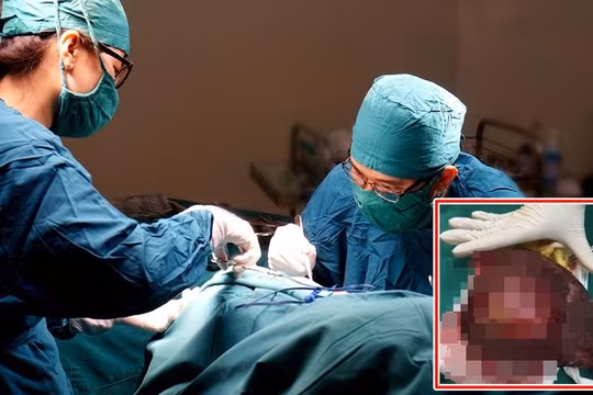 Lấy trọn khối u gan khổng lồ cứu sống bệnh nhân lớn tuổi