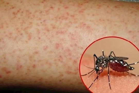 Muỗi vằn, tác nhân lây truyền bệnh sốt xuất huyết