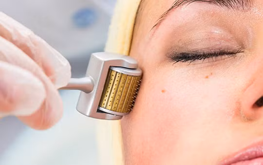 Lăn kim tại spa, một phụ nữ bị phù nề da mặt, mưng mủ. Ảnh minh họa: Internet