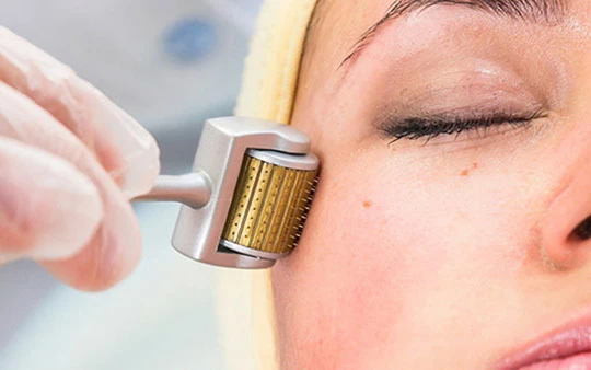 Lăn kim tại spa, một phụ nữ bị phù nề da mặt, mưng mủ. Ảnh minh họa: Internet