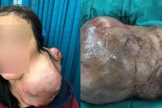 Bệnh viện Chợ Rẫy mổ tách thành công khối u nặng 3kg trên cổ bệnh nhân. Ảnh: BVCC