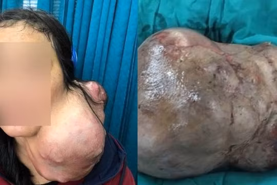 Bệnh viện Chợ Rẫy mổ tách thành công khối u nặng 3kg trên cổ bệnh nhân. Ảnh: BVCC