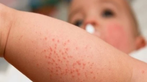 Bé trai 18 tháng tuổi bị sùi mào gà do ba vệ sinh không cẩn thận. Ảnh: Internet