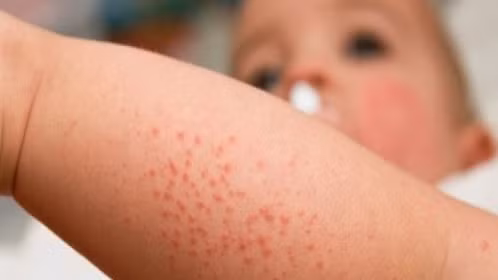 Bé trai 18 tháng tuổi bị sùi mào gà do ba vệ sinh không cẩn thận. Ảnh: Internet