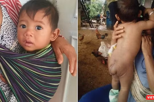 Bé trai 7 tháng tuổi người dân tộc Châu Mạ mang khối u khổng lồ ở mông