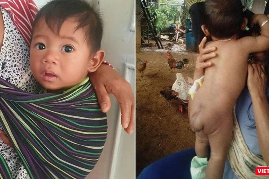 Bé trai 7 tháng tuổi người dân tộc Châu Mạ mang khối u khổng lồ ở mông