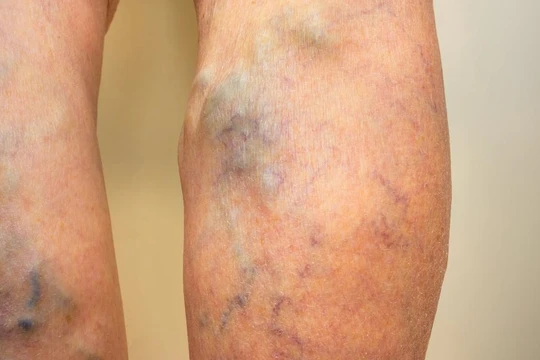 Đừng chủ quan với bệnh suy giãn tĩnh mạch. Ảnh: Medicalnewstoday