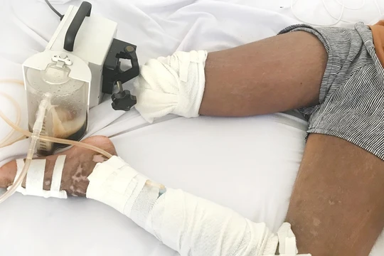 Điều trị rắn cắn bằng cách lễ, hút máu, bé gái 13 tuổi bị cắt chân.