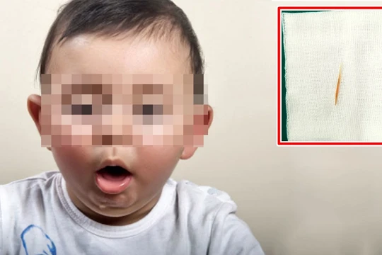Bé gái hơn 1 tuổi nuốt cây tăm dài 5cm vào dạ dày. Ảnh minh họa