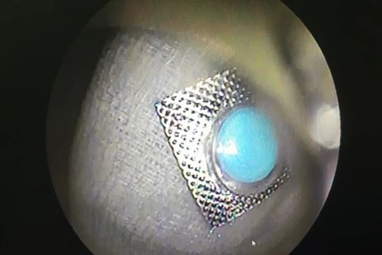 Bệnh nhân nuốt vỏ thuốc như dao bén vào thực quản. Ảnh: BV